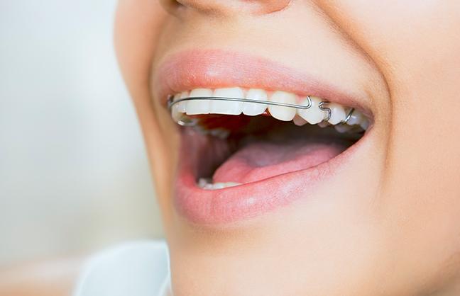 after-invisalign-treatment-invisalign-strathpoint-dental-family-general-dentist-strathmore-alberta