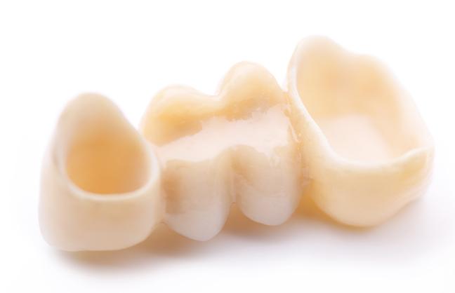 caring-for-your-dental-bridge-dental-bridges-strathpoint-dental-family-general-dentist-strathmore-alberta