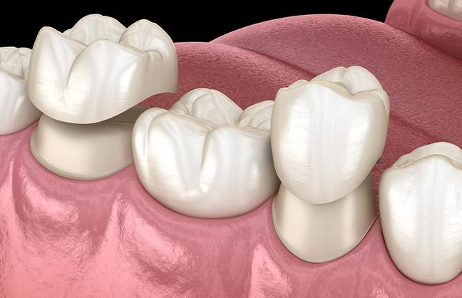 caring-for-your-dental-crown-dental-crowns-strathpoint-dental-family-general-dentist-strathmore-alberta