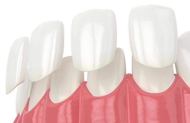 caring-for-your-veneers-porcelain-veneers-strathpoint-dental-family-general-dentist-strathmore-alberta