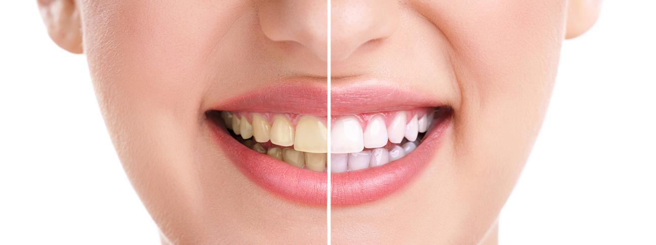 is-teeth-whitening-right-for-you-teeth-whitening-strathpoint-dental-family-general-dentist-strathmore-alberta
