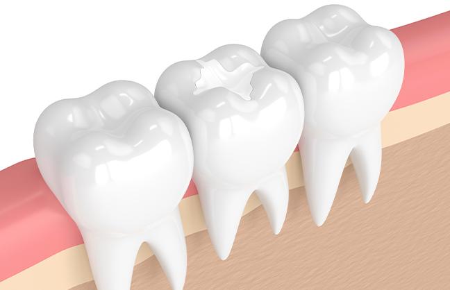 maintaining-your-fillings-dental-fillings-strathpoint-dental-family-general-dentist-strathmore-alberta