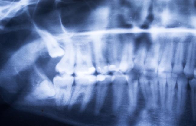 the-procedure-and-recovery-wisdom-teeth-extraction-strathpoint-dental-family-general-dentist-strathmore-alberta
