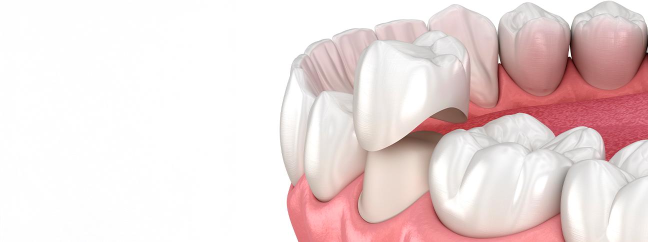 what-to-expect-during-the-crown-process-dental-crowns-strathpoint-dental-family-general-dentist-strathmore-alberta