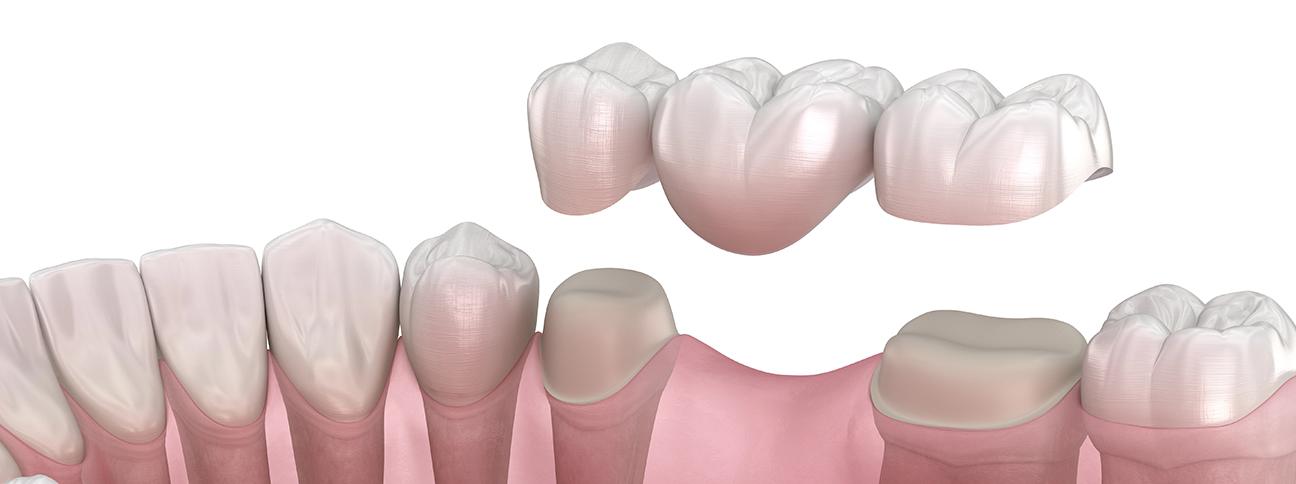 what-to-expect-during-the-dental-bridge-process-dental-bridges-strathpoint-dental-family-general-dentist-strathmore-alberta