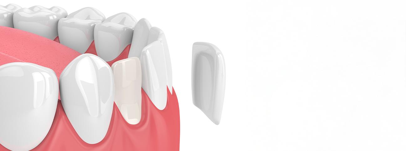 what-to-expect-during-the-veneer-process-porcelain-veneers-strathpoint-dental-family-general-dentist-strathmore-alberta