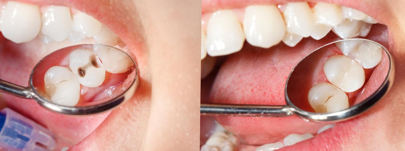 what-to-expect-during-treatment-dental-fillings-strathpoint-dental-family-general-dentist-strathmore-alberta